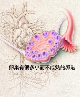 多囊性卵巢有很多小而不成熟的卵泡